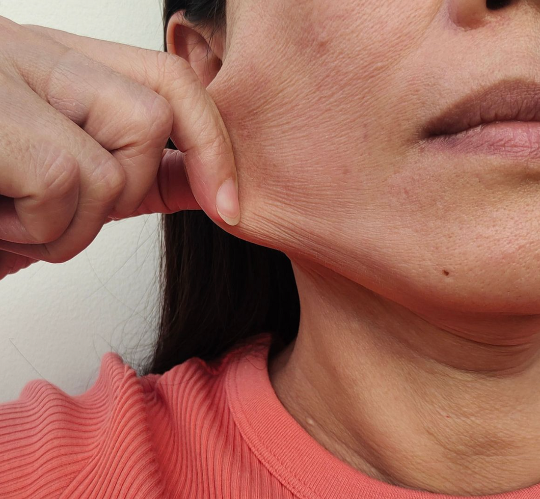Loose Skin After Weight Loss